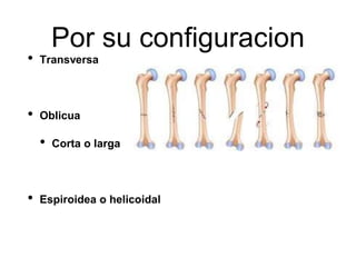 Por su configuracion
• Transversa
• Oblicua
• Corta o larga
• Espiroidea o helicoidal
 