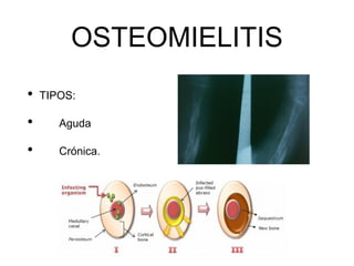 OSTEOMIELITIS
• TIPOS:
• Aguda
• Crónica.
 