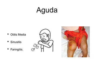 Aguda
• Otitis Media
• Sinusitis
• Faringitis.
 