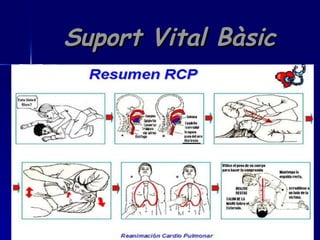 Suport Vital Bàsic 