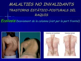 MALALTIES NO INVALIDANTS   TRASTORNS ESTÀTICO-POSTURALS DEL RAQUIS Ecoliosis: Desviament de la columna (vist per la part frontal). 