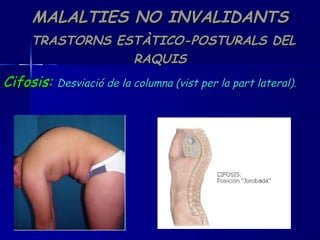 MALALTIES NO INVALIDANTS   TRASTORNS ESTÀTICO-POSTURALS DEL RAQUIS Cifosis:   Desviació de la columna (vist per la part lateral). 