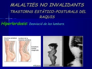 MALALTIES NO INVALIDANTS   TRASTORNS ESTÀTICO-POSTURALS DEL RAQUIS Hiperlordosis:   Desviació de les lumbars. 