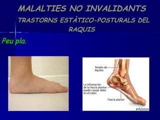 MALALTIES NO INVALIDANTS   TRASTORNS ESTÀTICO-POSTURALS DEL RAQUIS Peu pla. 