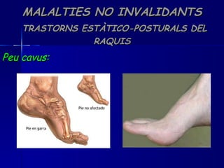 MALALTIES NO INVALIDANTS   TRASTORNS ESTÀTICO-POSTURALS DEL RAQUIS Peu cavus: 