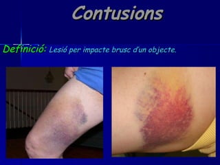 Contusions Definició:   Lesió per impacte brusc d’un objecte. 