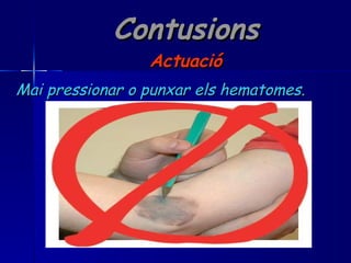 Contusions Actuació Mai pressionar o punxar els hematomes. 