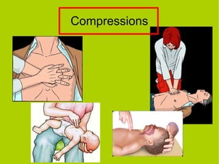 Compressions
 