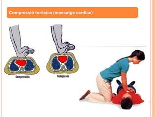 Compressió toràcica (massatge cardíac)
 
