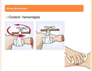  Contenir hemorràgies
Altres tècniques :
 
