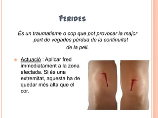 FERIDES
 Actuació : Aplicar fred
immediatament a la zona
afectada. Si és una
extremitat, aquesta ha de
quedar més alta que el
cor.
És un traumatisme o cop que pot provocar la major
part de vegades pèrdua de la continuïtat
de la pell.
 