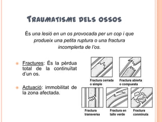 TRAUMATISME DELS OSSOS
 Fractures: És la pèrdua
total de la continuïtat
d’un os.
 Actuació: immobilitat de
la zona afectada.
És una lesió en un os provocada per un cop i que
produeix una petita ruptura o una fractura
incomplerta de l’os.
 
