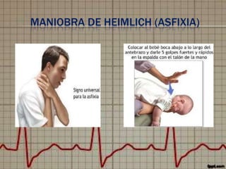 MANIOBRA DE HEIMLICH (ASFIXIA)

 