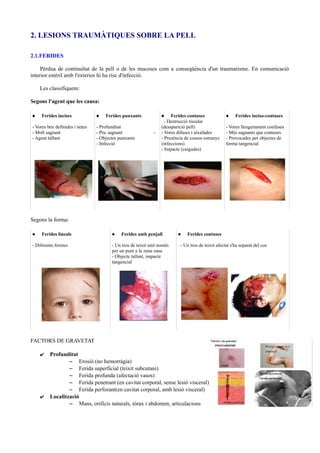 2. LESIONS TRAUMÀTIQUES SOBRE LA PELL
2.1.FERIDES
Pèrdua de continuïtat de la pell o de les mucoses com a conseqüència d'un traumatisme. En comunicació
interior estèril amb l'exterior hi ha risc d'infecció.
Les classifiquem:
Segons l'agent que les causa:
 Ferides incises
- Vores ben definides i netes
- Molt sagnant
- Agent tallant
 Ferides punxants
- Profunditat
- Poc sagnant -
- Objectes punxants
- Infecció
 Ferides contuses
- Destrucció tissular
(desaparició pell)
- Vores difuses i aixafades
- Presència de cossos estranys
(infeccions)
- Impacte (caigudes)
 Ferides inciso-contuses
- Vores lleugerament confuses
- Més sagnants que contuses
- Provocades per objectes de
forma tangencial
Segons la forma:
 Ferides lineals
- Diferents formes
 Ferides amb penjall
- Un tros de teixit unit només
per un punt a la zona sana
- Objecte tallant, impacte
tangencial
 Ferides contuses
- Un tros de teixit afectat s'ha separat del cos
FACTORS DE GRAVETAT
✔ Profunditat
– Erosió (no hemorràgia)
– Ferida superficial (teixit subcutani)
– Ferida profunda (afectació vasos)
– Ferida penetrant (en cavitat corporal, sense lesió visceral)
– Ferida perforant(en cavitat corporal, amb lesió visceral)
✔ Localització
– Mans, orificis naturals, tòrax i abdomen, articulacions
 