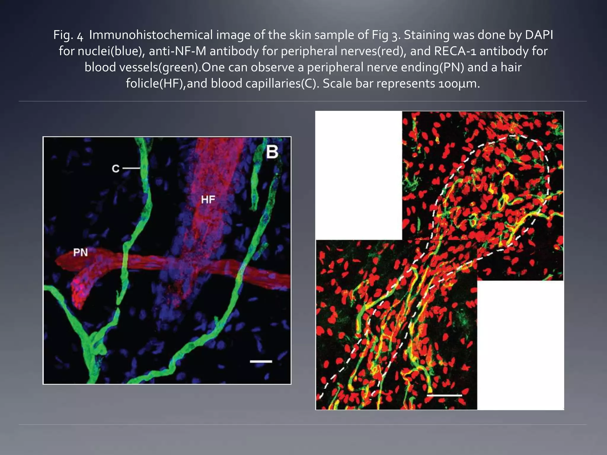 Fig. 4 Immunohistochemical image of the skin sample of Fig 3. Staining was done by DAPI
for nuclei(blue), anti-NF-M antibody for peripheral nerves(red), and RECA-1 antibody for
blood vessels(green).One can observe a peripheral nerve ending(PN) and a hair
folicle(HF),and blood capillaries(C). Scale bar represents 100µm.
 