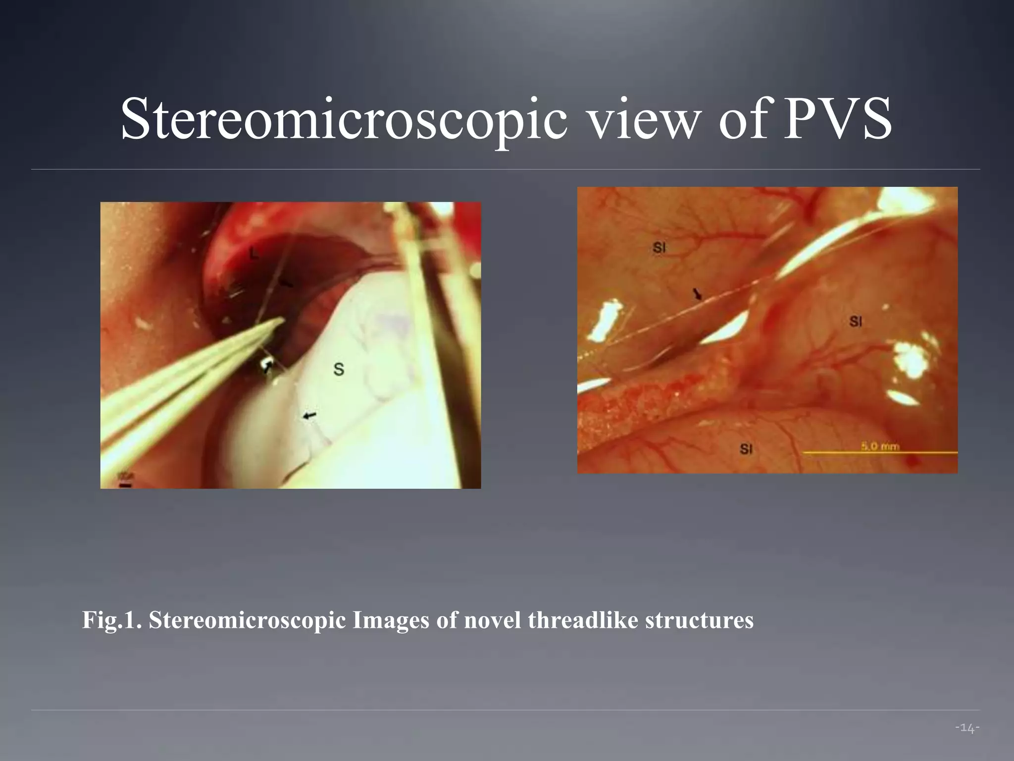 Stereomicroscopic view of PVS
-14-
Fig.1. Stereomicroscopic Images of novel threadlike structures
 