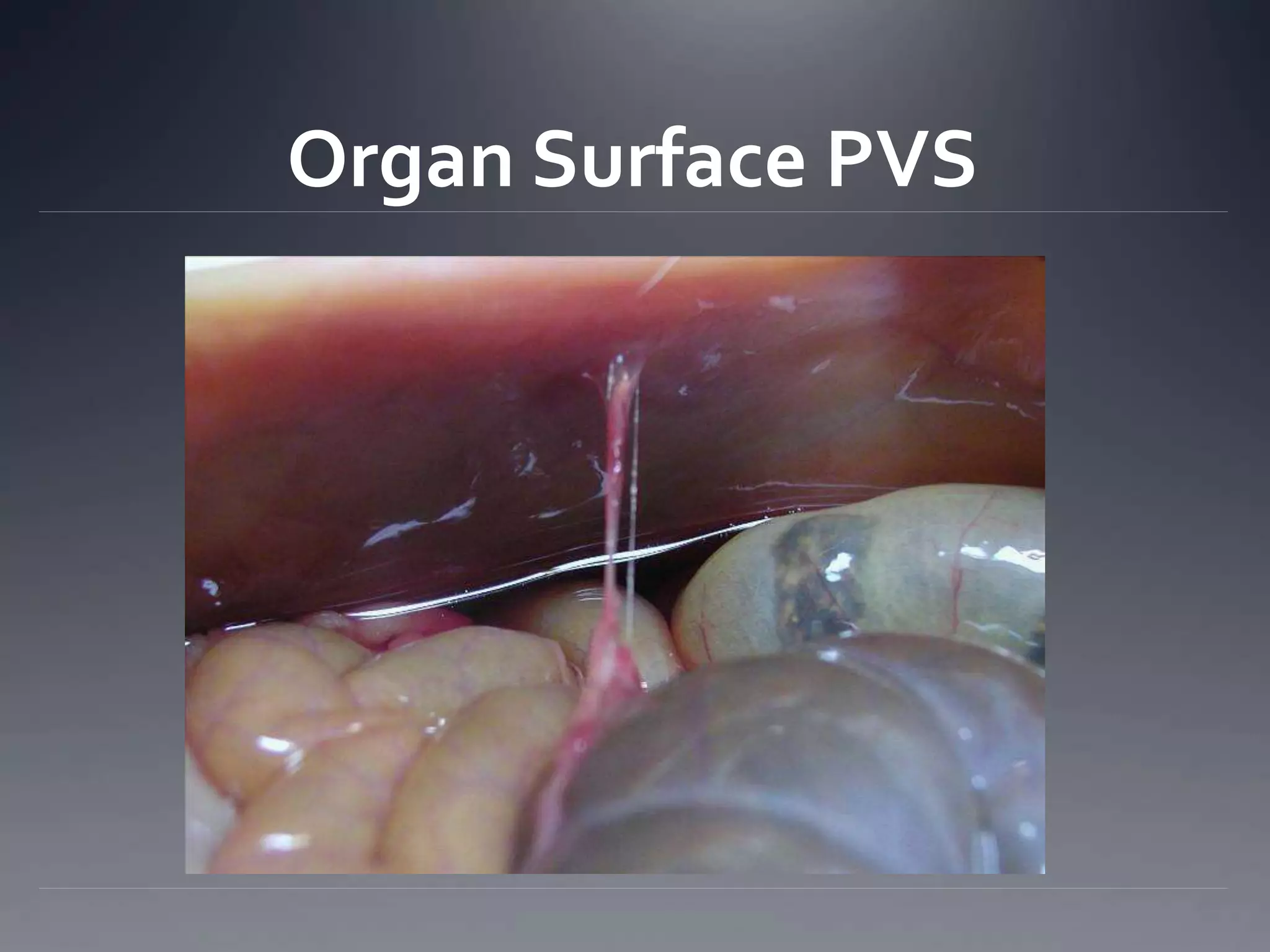 Organ Surface PVS
 