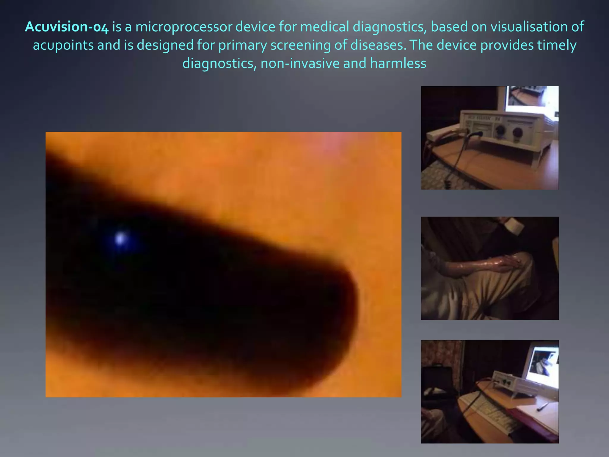 Acuvision-04 is a microprocessor device for medical diagnostics, based on visualisation of
acupoints and is designed for primary screening of diseases.The device provides timely
diagnostics, non-invasive and harmless
 