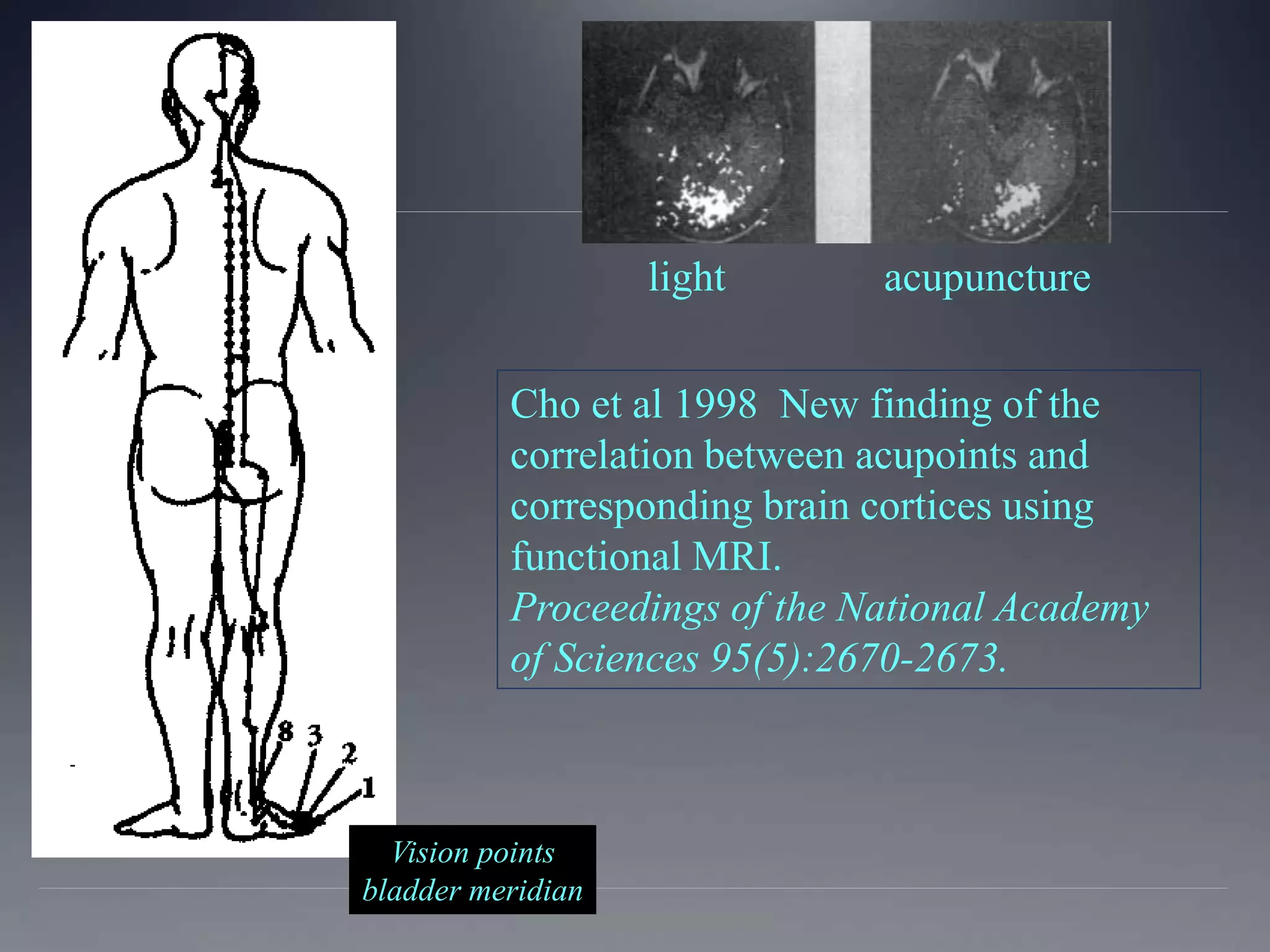 Cho et al 1998 New finding of the
correlation between acupoints and
corresponding brain cortices using
functional MRI.
Proceedings of the National Academy
of Sciences 95(5):2670-2673.
light acupuncture
Vision points
bladder meridian
 
