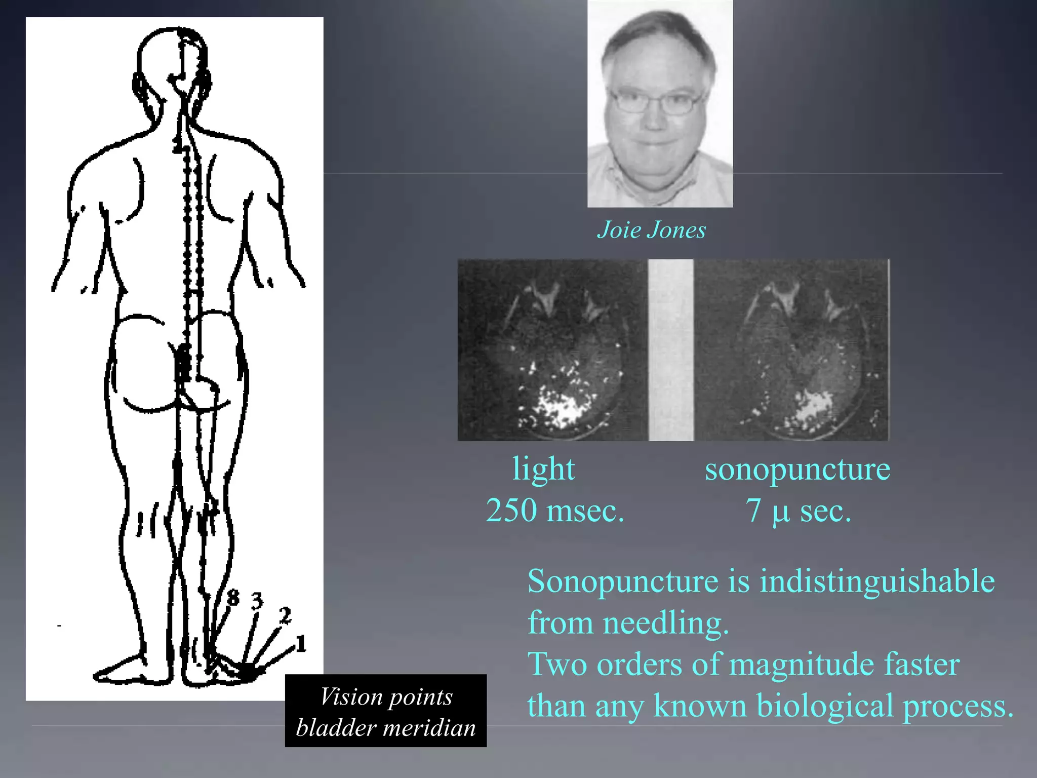 light sonopuncture
250 msec. 7  sec.
Vision points
bladder meridian
Joie Jones
Sonopuncture is indistinguishable
from needling.
Two orders of magnitude faster
than any known biological process.
 