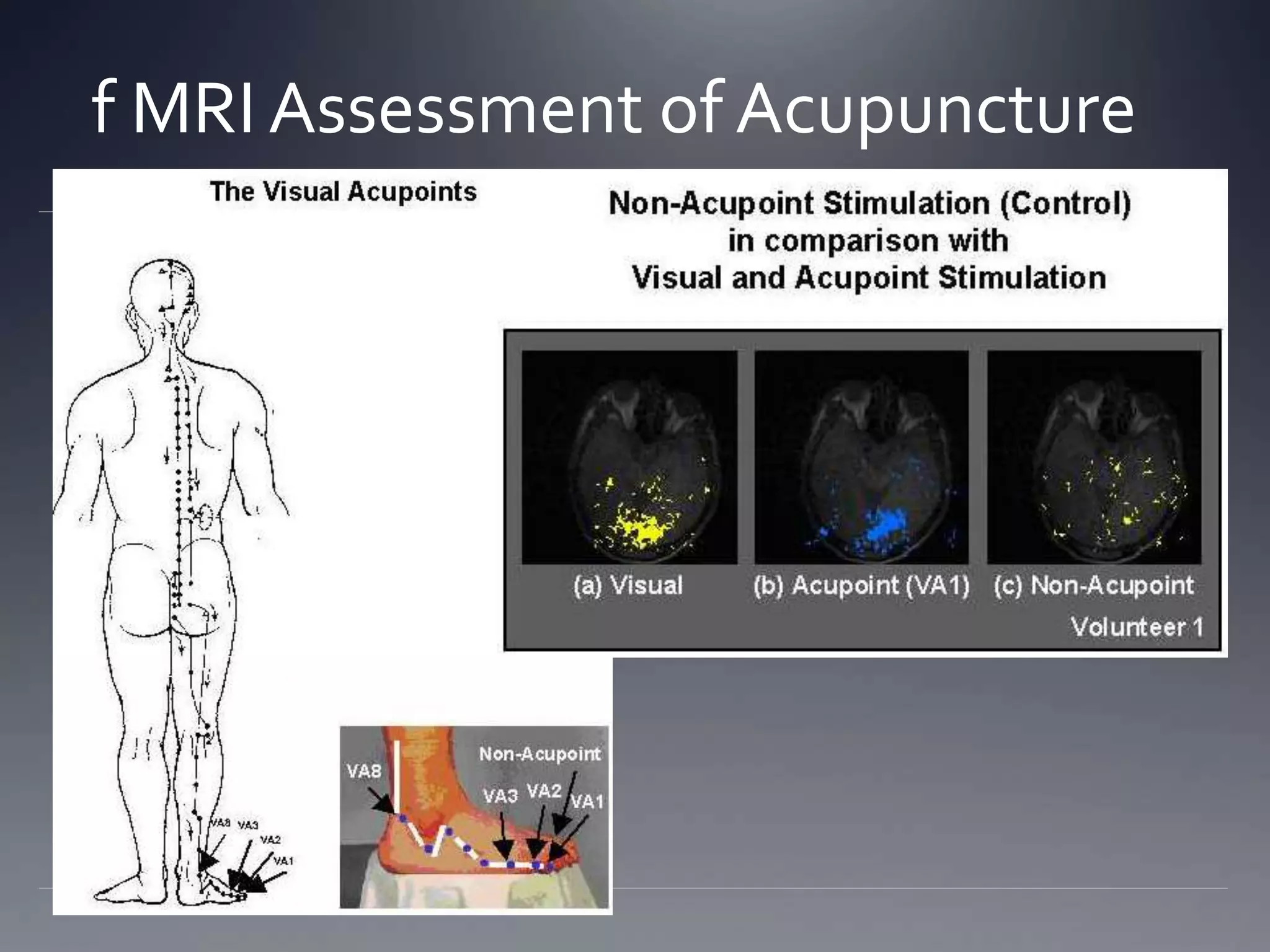 f MRI Assessment of Acupuncture
 