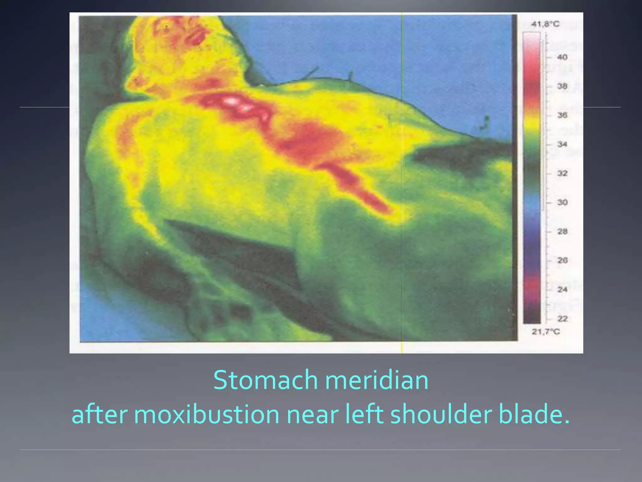 Stomach meridian
after moxibustion near left shoulder blade.
 