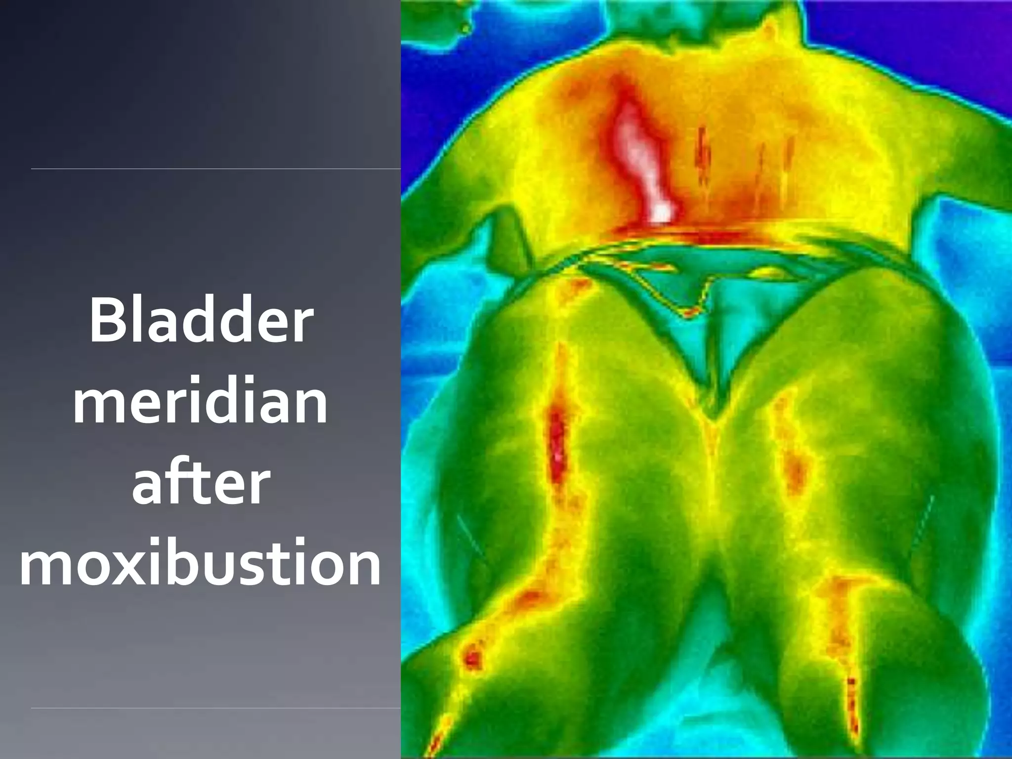 Bladder
meridian
after
moxibustion
 