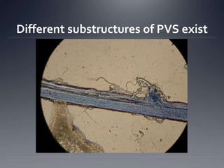 Different substructures of PVS exist
 