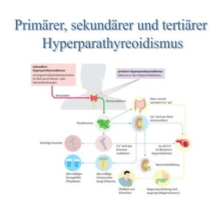 01.2 Primärer, sekundärer und tertiärer Hyperparathyreoidismus.