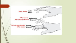 Comprehensive Overview of Flexor and Extensor Tendon Injuries of the ...