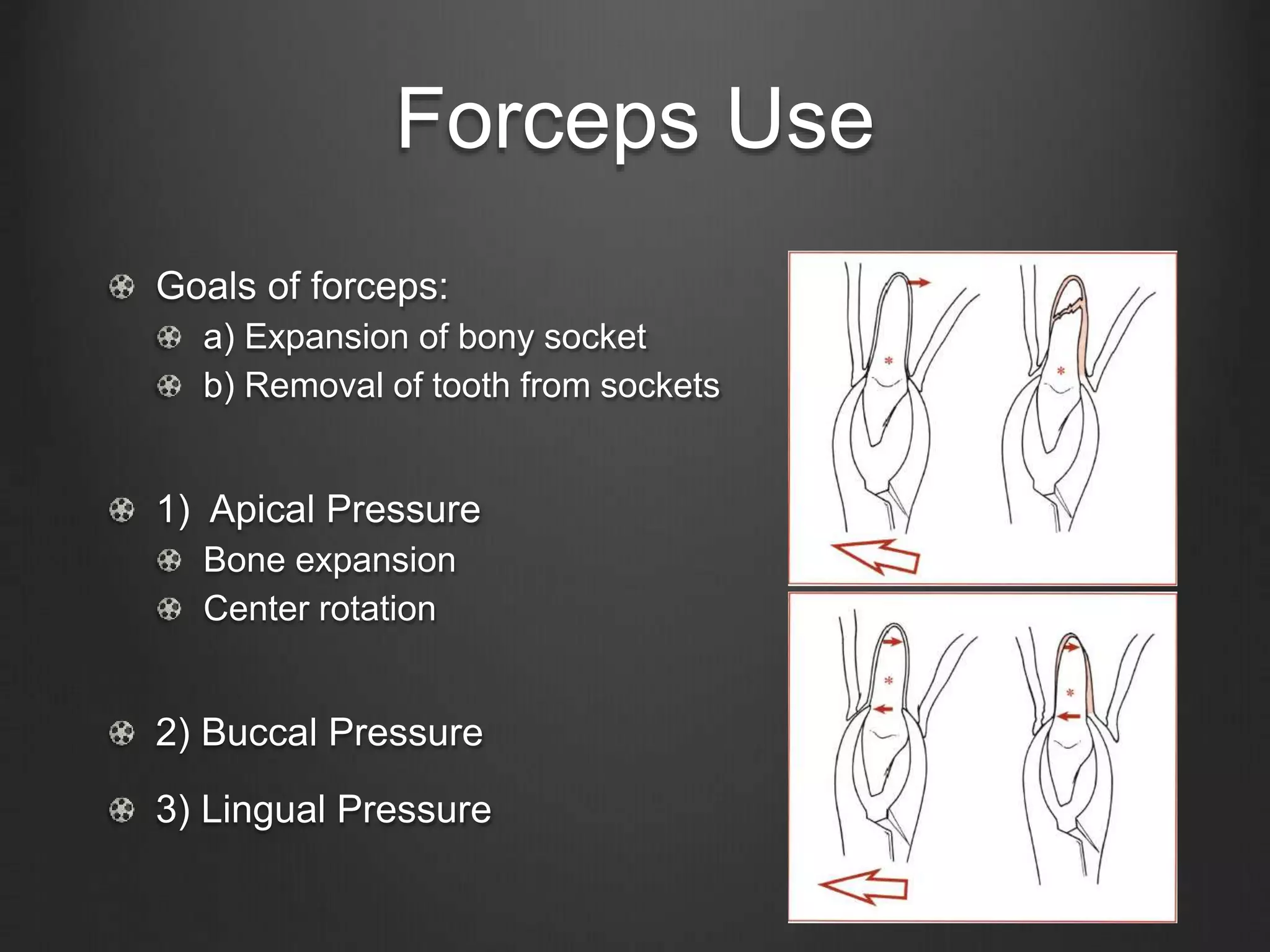 Forceps Use
Goals of forceps:
a) Expansion of bony socket
b) Removal of tooth from sockets
1) Apical Pressure
Bone expansion
Center rotation
2) Buccal Pressure
3) Lingual Pressure
 