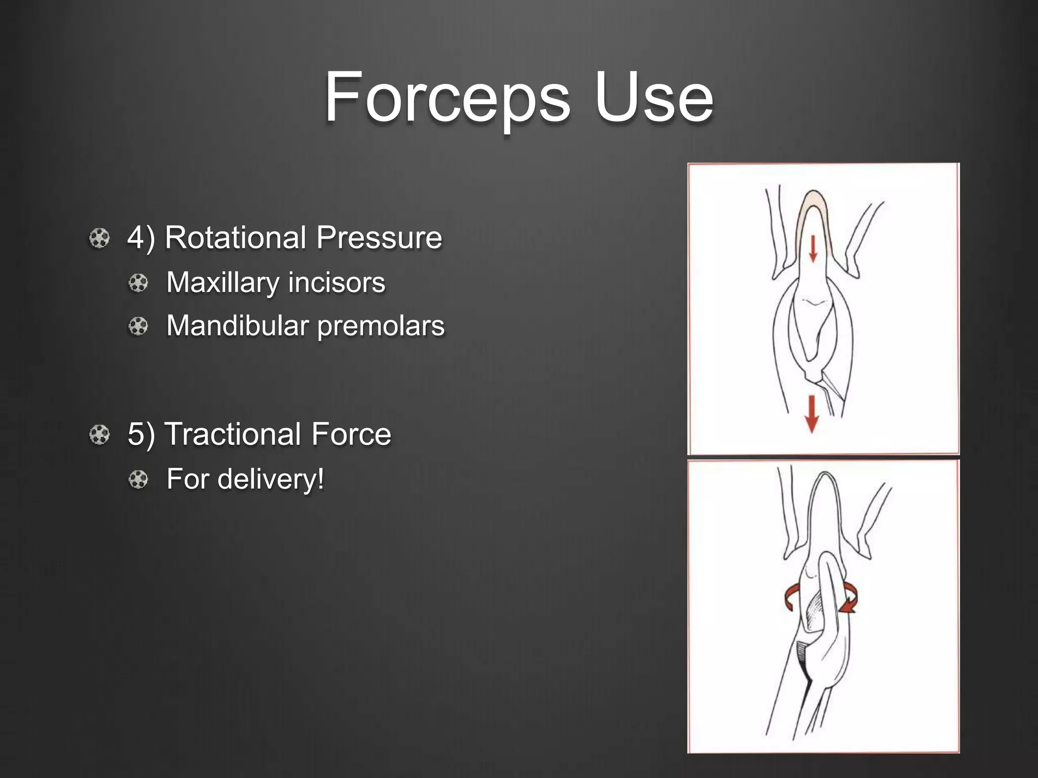 Forceps Use
4) Rotational Pressure
Maxillary incisors
Mandibular premolars
5) Tractional Force
For delivery!
 