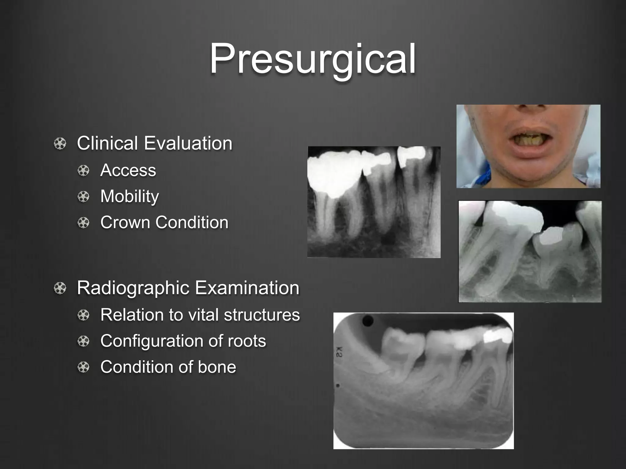 Presurgical
Clinical Evaluation
Access
Mobility
Crown Condition
Radiographic Examination
Relation to vital structures
Configuration of roots
Condition of bone
 