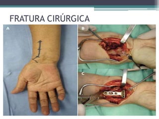 FRATURA CIRÚRGICA
 