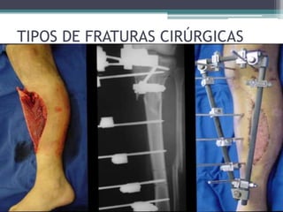 TIPOS DE FRATURAS CIRÚRGICAS
 