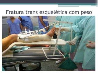 Fratura trans esquelética com peso
 