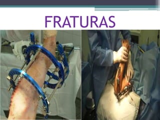 FRATURAS
 