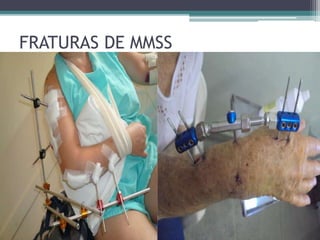 FRATURAS DE MMSS
 