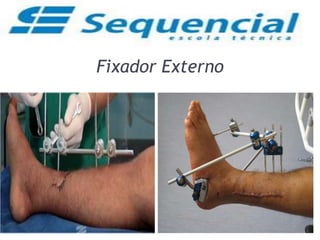 Fixador Externo
 