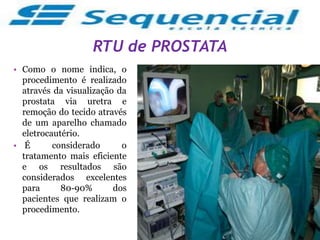RTU de PROSTATA
• Como o nome indica, o
procedimento é realizado
através da visualização da
prostata via uretra e
remoção do tecido através
de um aparelho chamado
eletrocautério.
• É considerado o
tratamento mais eficiente
e os resultados são
considerados excelentes
para 80-90% dos
pacientes que realizam o
procedimento.
 