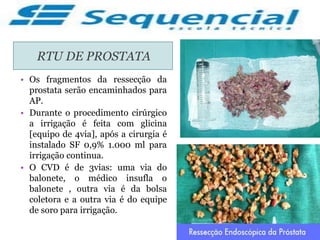 RTU DE PROSTATA
• Os fragmentos da ressecção da
prostata serão encaminhados para
AP.
• Durante o procedimento cirúrgico
a irrigação é feita com glicina
[equipo de 4via], após a cirurgia é
instalado SF 0,9% 1.000 ml para
irrigação continua.
• O CVD é de 3vias: uma via do
balonete, o médico insufla o
balonete , outra via é da bolsa
coletora e a outra via é do equipe
de soro para irrigação.
 