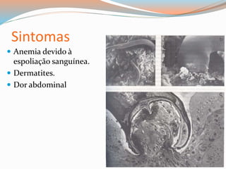  Anemia devido à
espoliação sanguínea.
 Dermatites.
 Dor abdominal
Sintomas
 
