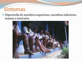  Hipertrofia de membros superiores, membros inferiores,
mamas e testículos.
Sintomas
 