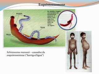 Schistosoma mansoni – causador da
esquistossomose (“barriga d’água”)
Esquistossomose
 