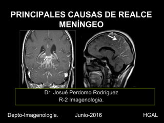 PRINCIPALES CAUSAS DE REALCE
MENÍNGEO
Dr. Josué Perdomo Rodríguez
R-2 Imagenologia.
Depto-Imagenologia. Junio-2016 HGAL
 