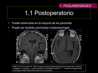 1.1 Postoperatorio
• Puede observarse en la mayoría de los pacientes
• Puede ser también parcheado o leptomeníngeo
1. PAQUIMENÍNGEO
A B
RM T1+C de un varón de 78 tras cirugía de masa parietal izquierda que resultó ser un linfoma.
Imágenes A) coronal y B) axial muestran un hematoma subdural y realce meníngeo lineal
que sigue la tabla interna del cráneo y la hoz cerebral
 