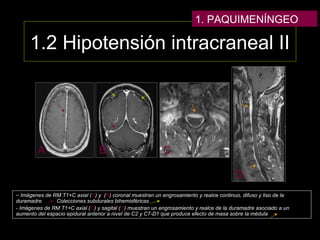 1.2 Hipotensión intracraneal II
A B C
D
– Imágenes de RM T1+C axial (A) y (B) coronal muestran un engrosamiento y realce continuo, difuso y liso de la
duramadre Colecciones subdurales bihemisféricas
- Imágenes de RM T1+C axial (C) y sagital (D) muestran un engrosamiento y realce de la duramadre asociado a un
aumento del espacio epidural anterior a nivel de C2 y C7-D1 que produce efecto de masa sobre la médula
1. PAQUIMENÍNGEO
 