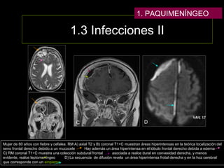 1.3 Infecciones II
Mujer de 80 años con fiebre y cefalea. RM A) axial T2 y B) coronal T1+C muestran áreas hiperintensas en la teórica localización del
seno frontal derecho debido a un mucocele Hay además un área hiperintensa en el lóbulo frontal derecho debida a edema
C) RM coronal T1+C muestra una colección subdural frontal asociada a realce dural en convexidad derecha, y menos
evidente, realce leptomeníngeo D) La secuencia de difusión revela un área hiperintensa frotal derecha y en la hoz cerebral
que corresponde con un empiema
A
B
C D
1. PAQUIMENÍNGEO
 