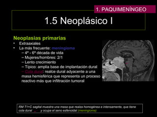1.5 Neoplásico I
Neoplasias primarias
• Extraaxiales
• La más frecuente: meningioma
– 4ª - 6ª década de vida
– Mujeres/hombres: 2/1
– Lento crecimiento
– Típico: amplia base de implantación dural
– Cola dural: realce dural adyacente a una
masa hemisférica que representa un proceso
reactivo más que infiltración tumoral
RM T1+C sagital muestra una masa que realza homogénea e intensamente, que tiene
cola dural y ocupa el seno esfenoidal (meningioma)
1. PAQUIMENÍNGEO
 