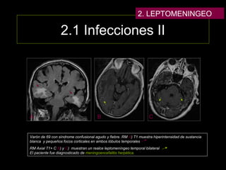2.1 Infecciones II
Varón de 69 con síndrome confusional agudo y fiebre. RM A) T1 muestra hiperintensidad de sustancia
blanca y pequeños focos corticales en ambos lóbulos temporales
RM Axial T1+ C B) y C) muestran un realce leptomeníngeo temporal bilateral
El paciente fue diagnosticado de meningoencefalitis herpética.
A B C
2. LEPTOMENINGEO
 